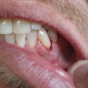 Gum Tissue that Bleeds